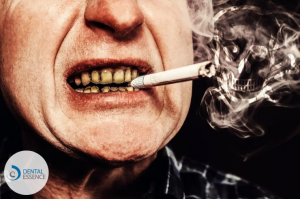 The Impact of Smoking on Dental Implants: Risks and Recommendations